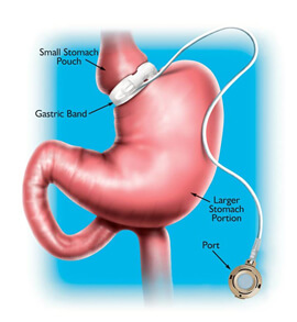 Cirurgia do estômago - Banda Gástrica - o médico irá inserir um anel em torno do estômago, fazendo com que ele diminua de tamanho.