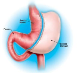 Cirurgia do estômago - Gastrectomia vertical ou sleeve - remove-se uma parte do estômago e mantém a forma natural de ligação com o intestino.