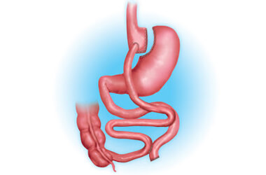 Sintomas de fistula após Cirurgia Bariátrica - Baricare - Dr. Gustavo  Fernandes