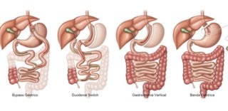 Sintomas de fistula após Cirurgia Bariátrica - Baricare - Dr. Gustavo  Fernandes