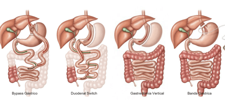 Cirurgia Bari Trica Bypass E Sleeve Quais S O As Diferen As Baricare Dr Gustavo Fernandes